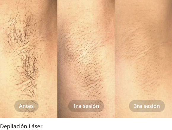 depilacion_laser_1