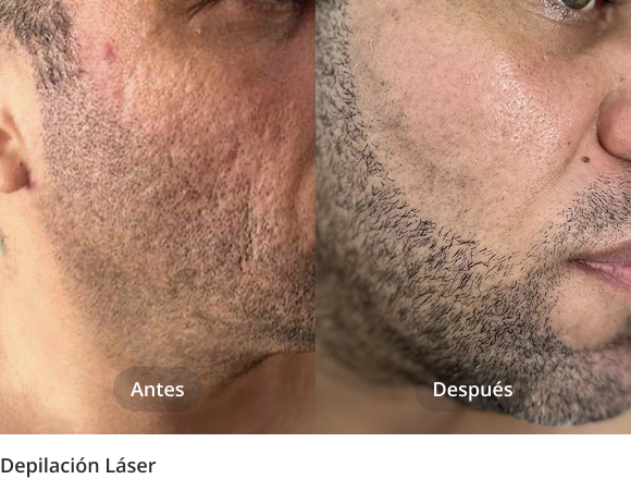 depilacion_laser_2